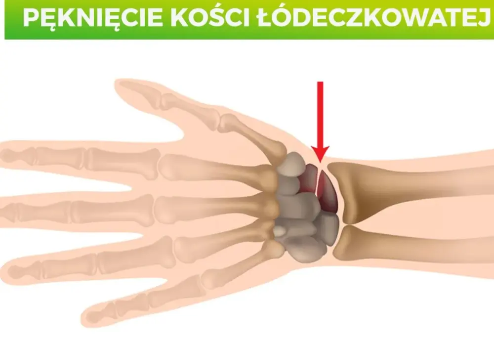 Ból kciuka po upadku? To może być złamanie kości łódeczkowatej