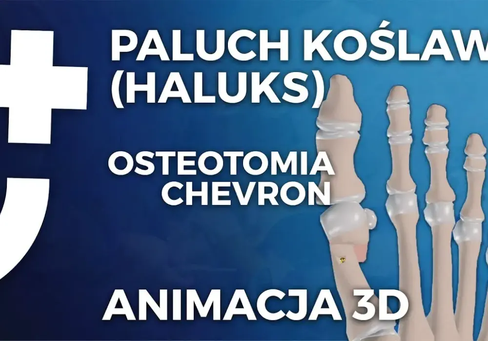 Gdzie operować haluksy na NFZ? Sprawdź dostępne placówki i terminy