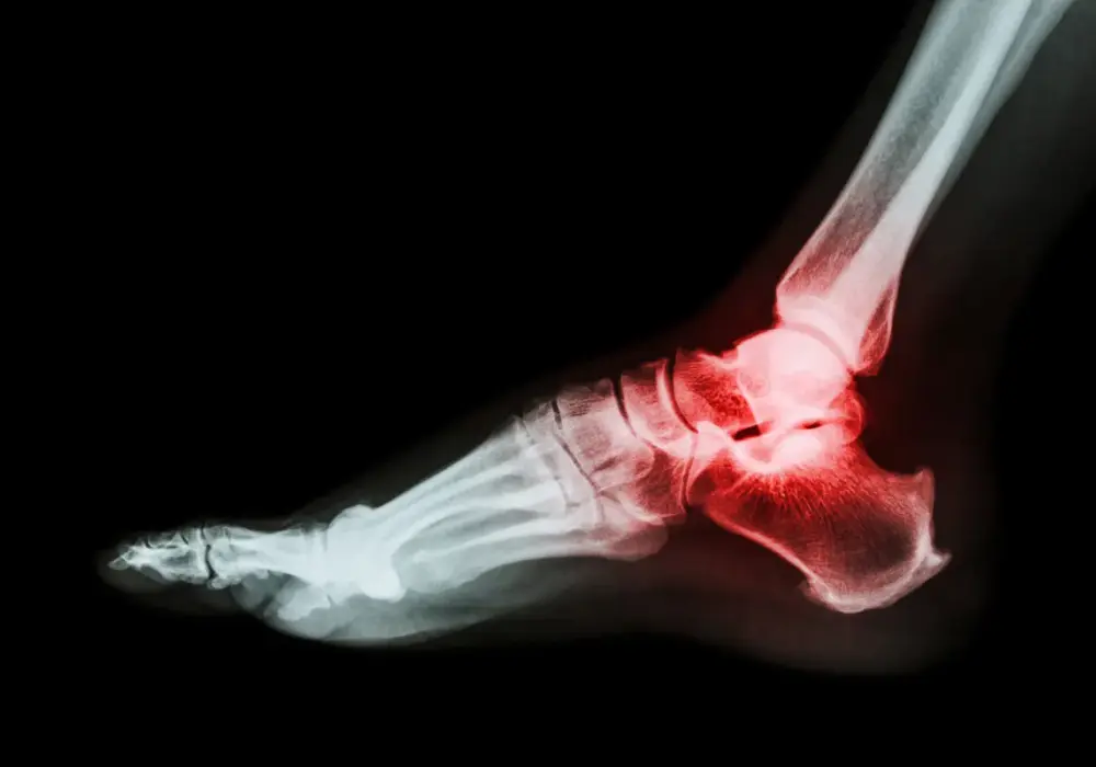 Kość piętowa - anatomia, ból. Czy to zawsze problem kości?