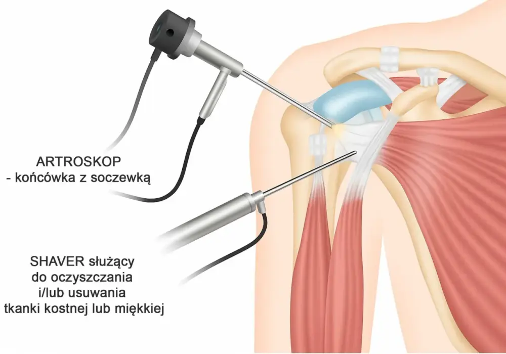 Staw barkowo-obojczykowy - Ból barku? Diagnoza i skuteczne leczenie