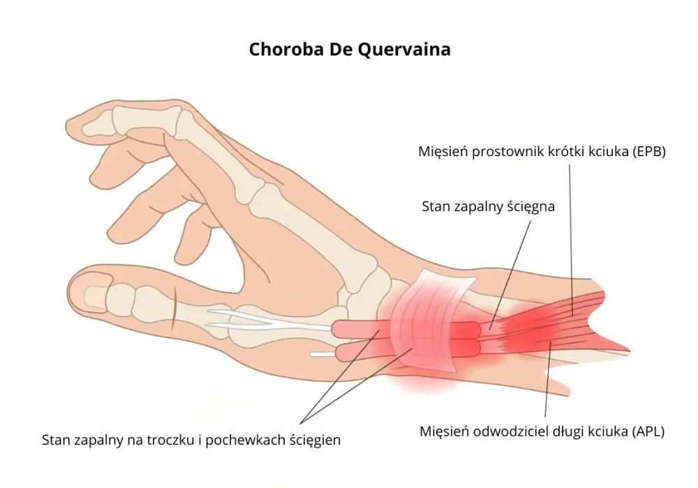 Ból kciuka nadgarstka - Choroba de Quervaina - Co naprawdę pomaga?