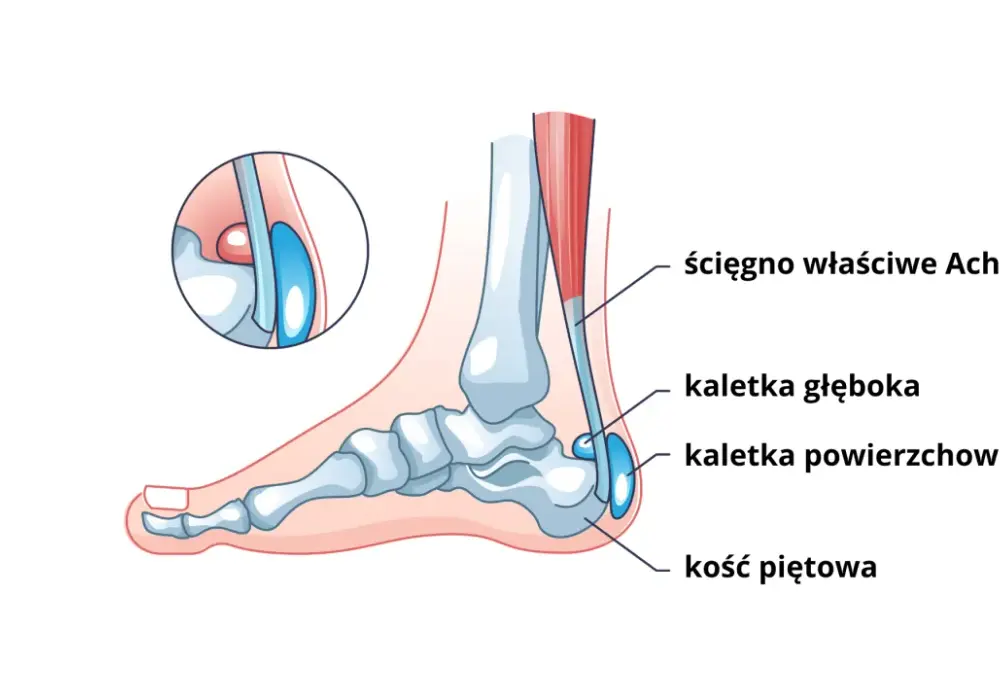 Ból nad piętą - Achilles czy kaletka? Poznaj przyczynę i leczenie