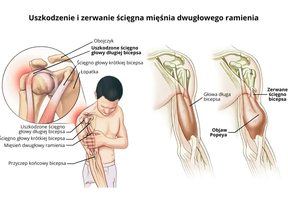 Kość ramienna - budowa, funkcja, urazy. Rozpoznaj objawy!