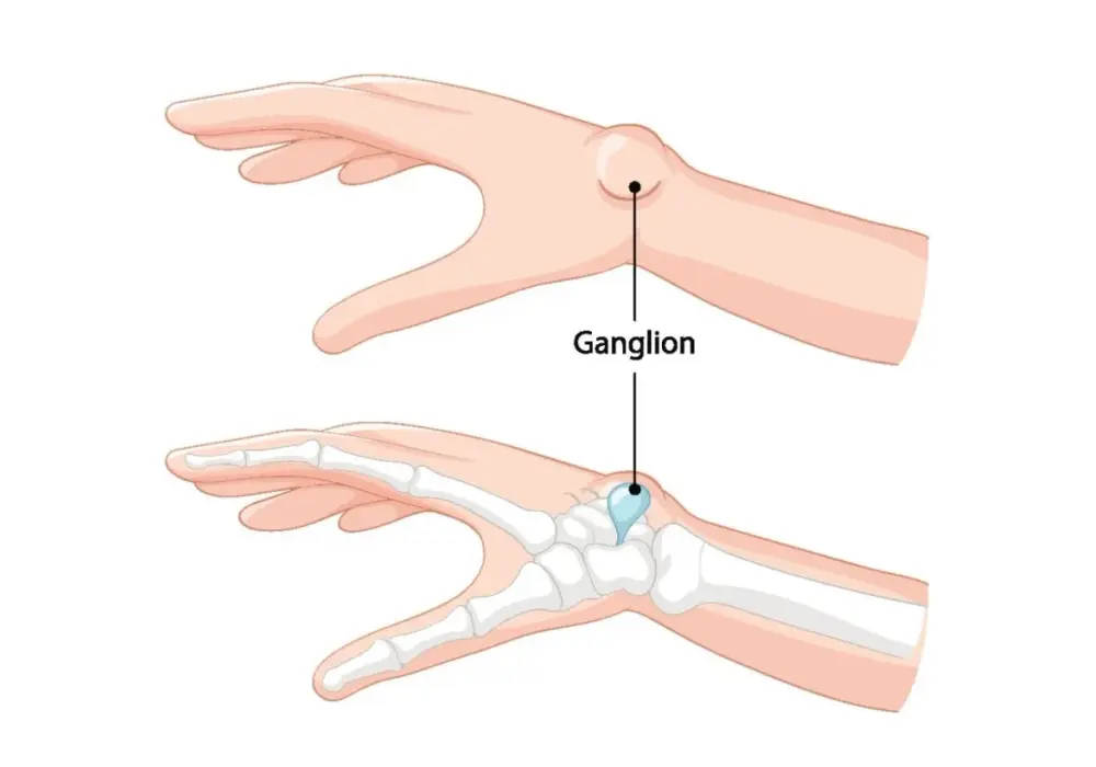 Masz guzek? Ganglion - objawy, leczenie i kiedy iść do ortopedy