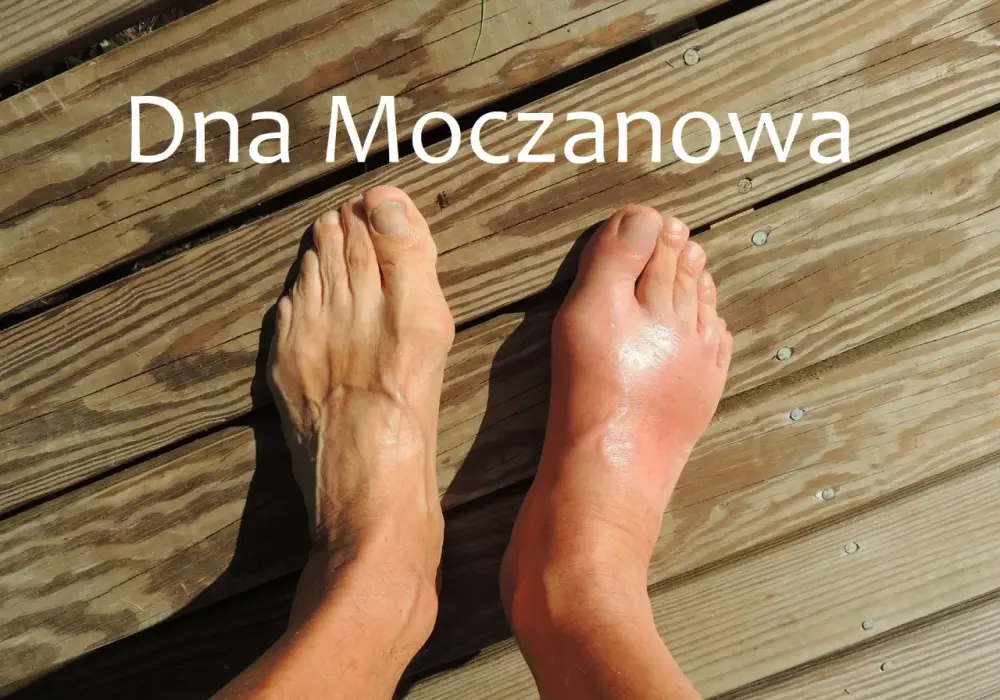 Ból pięty - Dna moczanowa czy inne przyczyny? Sprawdź!