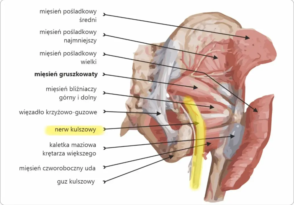 Ból pośladka - Zespół mięśnia gruszkowatego czy rwa?