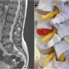 MRI kręgosłupa lędźwiowego i model krążka międzykręgowego z uciskiem na nerw.