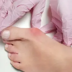 Jaki lekarz leczy haluksy? Klucz do skutecznego leczenia bólu stóp