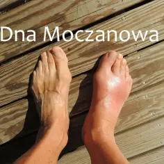 Widoczne objawy dny moczanowej: zaczerwieniony, opuchnięty staw palucha stopy po prawej, zdrowa stopa po lewej.