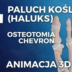 Gdzie operować haluksy na NFZ? Sprawdź dostępne placówki i terminy