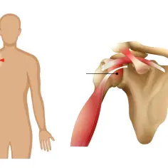 Ból w ramieniu, z zaznaczonym obszarem bólu. Detal anatomiczny pokazuje staw barkowy z mięśniem obłym większym (teres major) i ścięgnami.