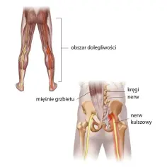 Ilustracja anatomiczna ukazująca nerw kulszowy i jego promieniowanie do stopy.