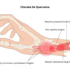Anatomia dłoni z zaznaczonym stanem zapalnym ścięgien kciuka, objawem choroby De Quervaina.