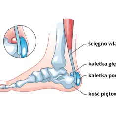 Anatomia stopy z zaznaczonym ścięgnem Achillesa i kaletkami, które mogą powodować straszny ból nad piętą przy chodzeniu.