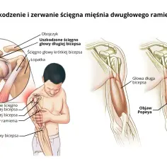 Ilustracja pokazuje uszkodzenie i zerwanie ścięgna mięśnia dwugłowego ramienia, w tym kość ramienna i objaw Popeya.