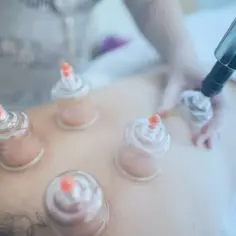Masaż bańką chińską na plecach. Terapeuta umieszcza szklane bańki, tworząc podciśnienie.
