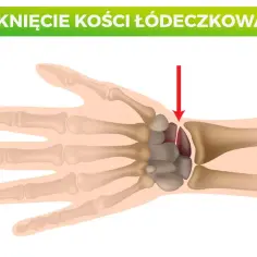 Ilustracja anatomiczna nadgarstka z zaznaczonym pęknięciem kości łódeczkowatej.