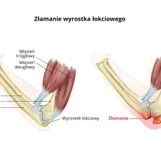 Ilustracja anatomiczna łokcia: zdrowy staw i złamanie wyrostka łokciowego z opuchlizną.