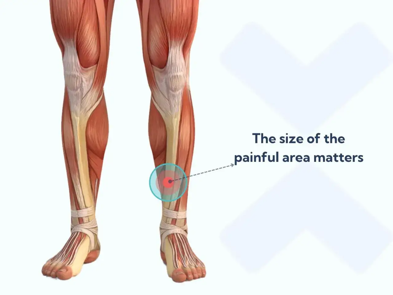 Anatomia łydki z zaznaczonym obszarem bólu, sugerującym zapalenie okostnej. Wielkość bólu ma znaczenie.