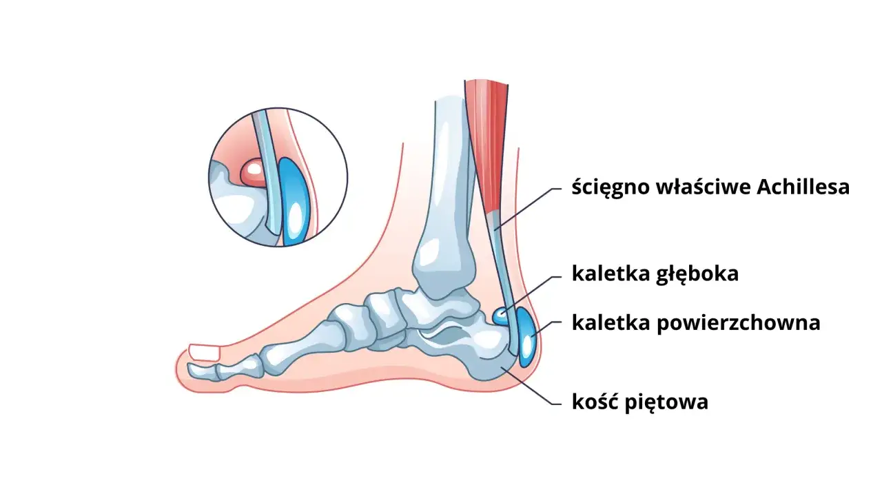 Anatomia ścięgna Achillesa i kaletek. Ból nad piętą przy chodzeniu może być związany z zapaleniem tych struktur.