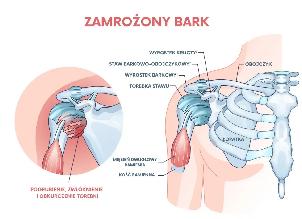Ilustracja przedstawia staw barkowo-obojczykowy i jego okolice, ukazując pogrubienie, zwłóknienie i obkurczenie torebki stawowej w zamrożonym barku.