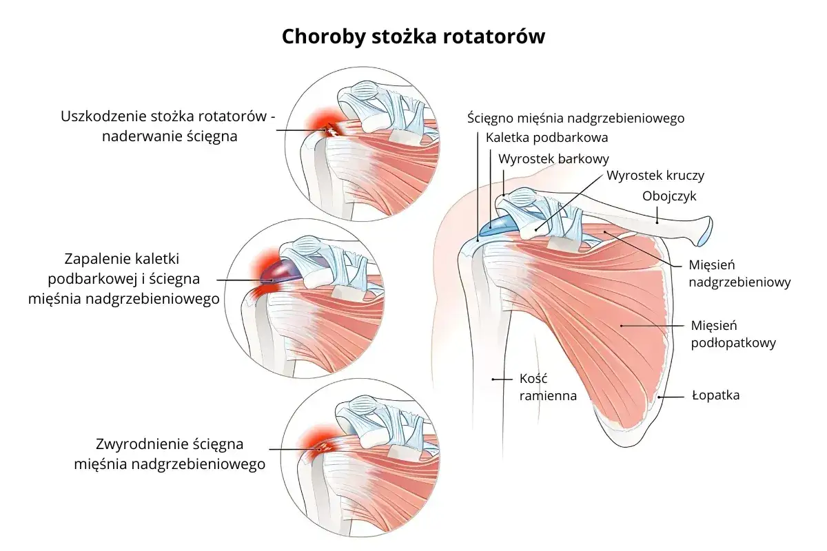 Ilustracja pokazuje przyczyny bólu barku, w tym uszkodzenia stożka rotatorów, zapalenie kaletki i zwyrodnienie ścięgna. ICD-10 koduje te schorzenia.