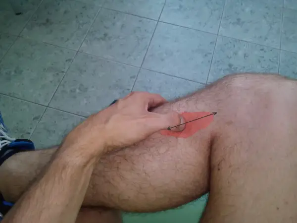 Mięsień podkolanowy - Klucz do stabilności kolana?