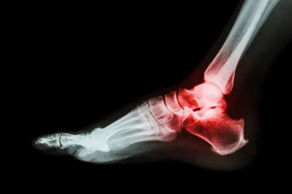 Kość piętowa - anatomia, ból. Czy to zawsze problem kości?