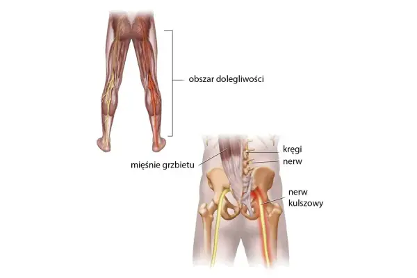 Nerw kulszowy - anatomia i ból. Dlaczego promieniuje do stopy?