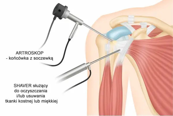 Staw barkowo-obojczykowy - Ból barku? Diagnoza i skuteczne leczenie