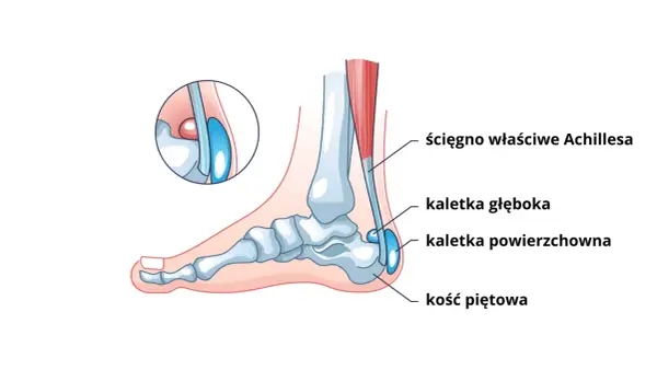 Ból nad piętą - Achilles czy kaletka? Poznaj przyczynę i leczenie