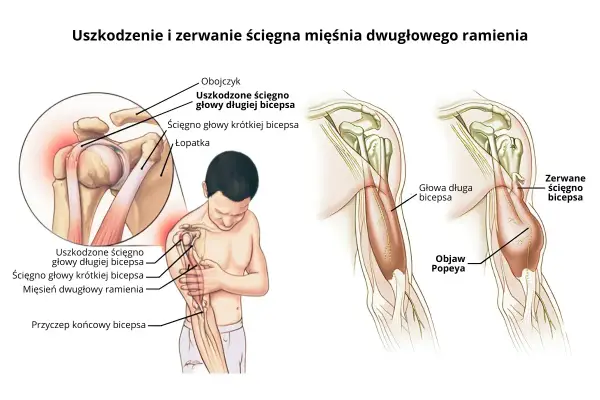 Kość ramienna - budowa, funkcja, urazy. Rozpoznaj objawy!