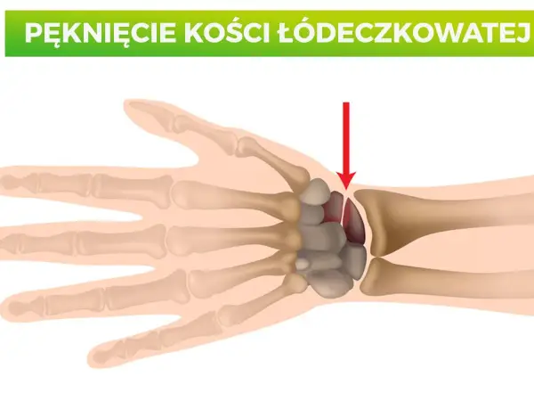 Kości nadgarstka - budowa, funkcja i najczęstsze błędy