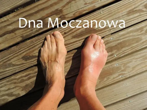 Ból pięty - Dna moczanowa czy inne przyczyny? Sprawdź!