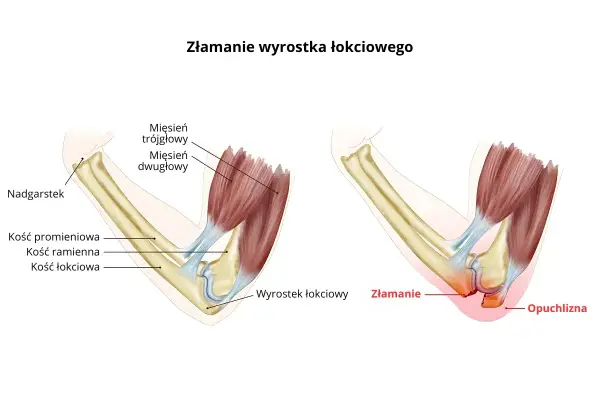 Łokieć - budowa, ruch i problemy. Poznaj swój staw!
