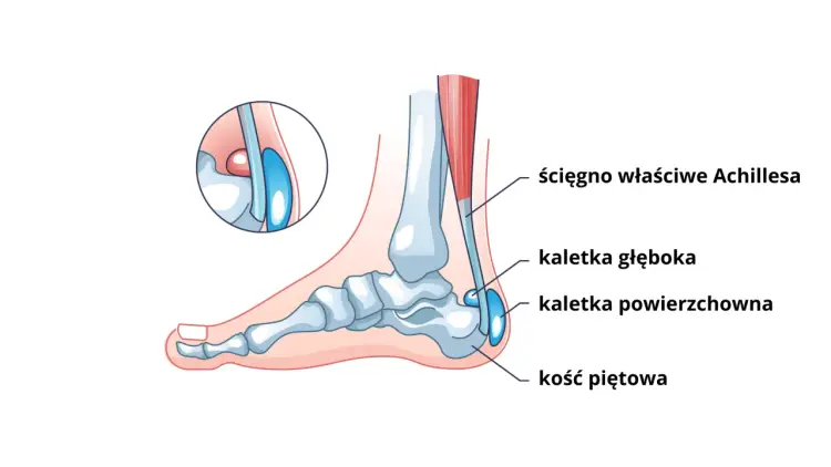 Ból nad piętą - Achilles czy kaletka? Poznaj przyczynę i leczenie